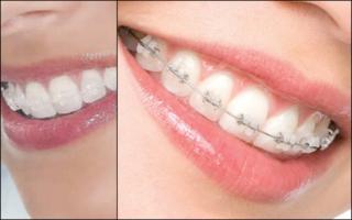 Implantes Dentrios e Prtese no Santa Efignia BH