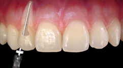 Clarus - Clareamento Dental no Santa Efignia BH - Cirurgio Dentista no Santa Efignia BH - Implantes no Santa Efignia BH