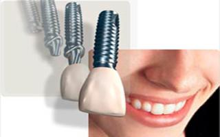   Implantes no Santa Efignia BH - Ortodontia no Santa Efignia BH  - Implantes Dentrios e Prtese no Santa Efignia BH